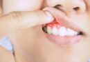 Is a Dental Abscess an Oral Health Emergency?