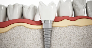 What Are the Different Types of Dental Implants That Exist Today?