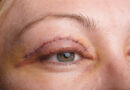 Top 5 Signs You Need Blepharoplasty Surgery