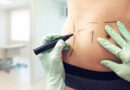 5 Tummy Tuck Recovery Tips You Need to Remember