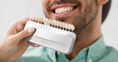 How Much Do Veneers Cost? A Price Guide