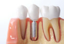 How to Pick Dental Implants: Everything You Need to Know