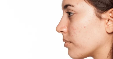 How To Check Hormonal Acne, Pimple Signs, and Its Treatment with Natural Remedies
