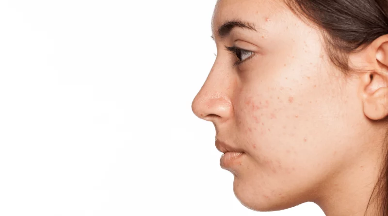 How To Check Hormonal Acne, Pimple Signs, and Its Treatment with Natural Remedies